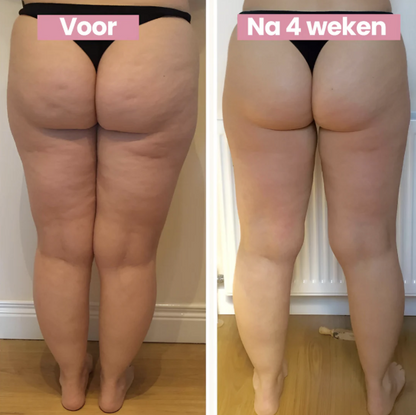 Cellucup™ | Anticellulite & Huidverstrakking Behandeling